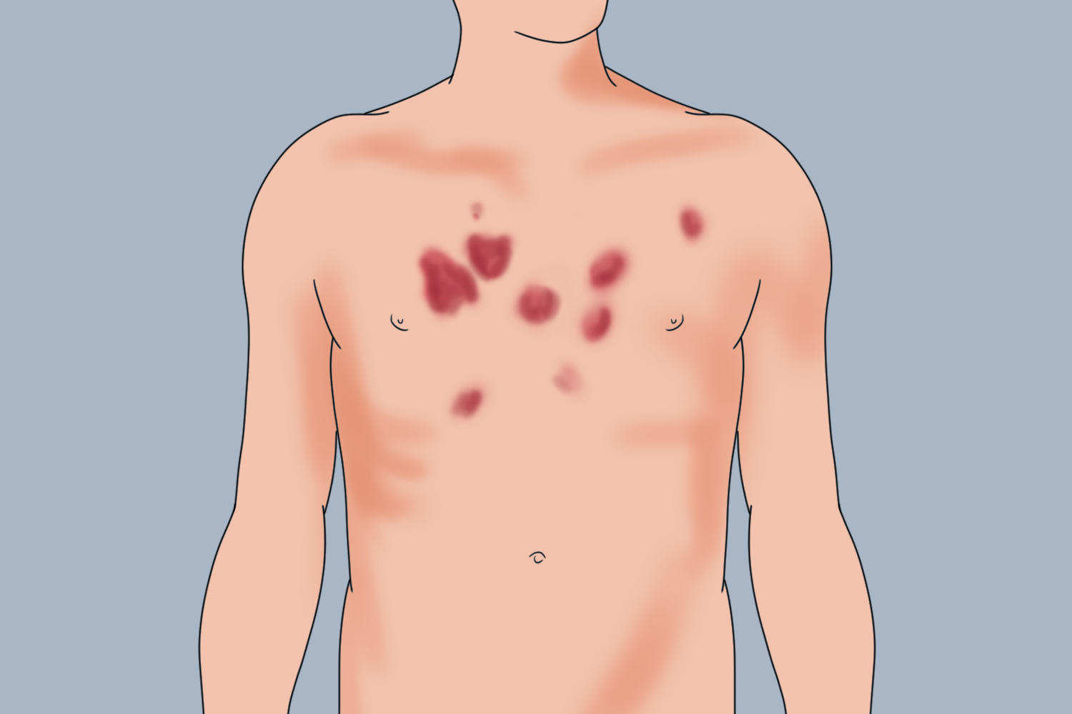 胸口结节性红斑图