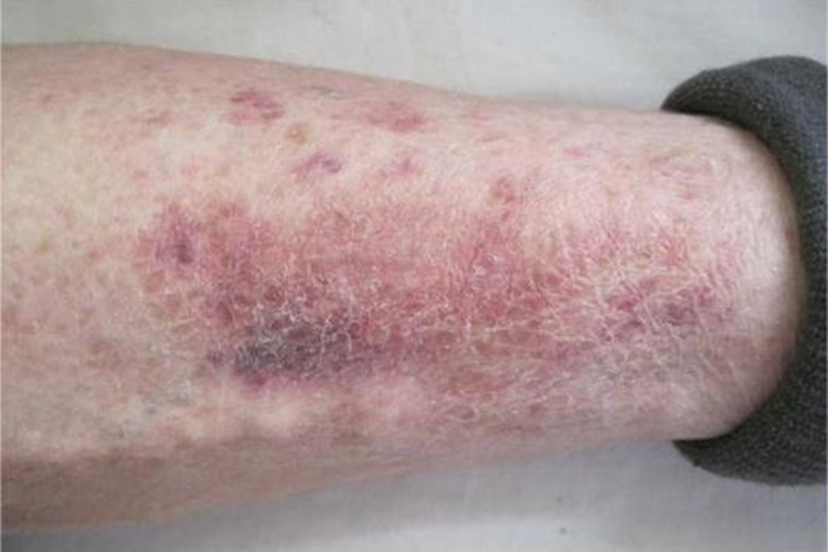 变应性皮肤血管炎小腿脱屑图 变应性皮肤血管炎小腿脱屑图