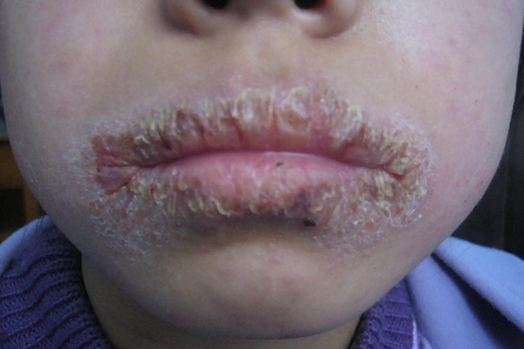 口周慢性湿疹口周结厚痂图
