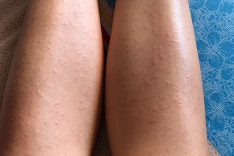 海水浴者皮疹小腿丘疹图