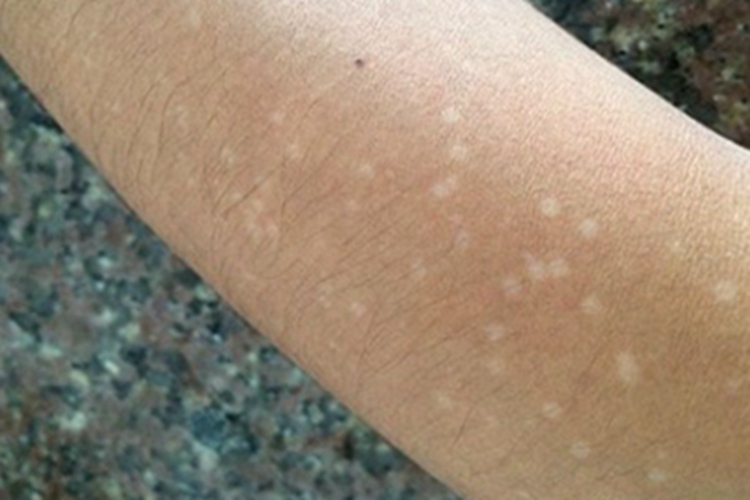 白癜风胳膊白点图 白癜风胳膊白点图