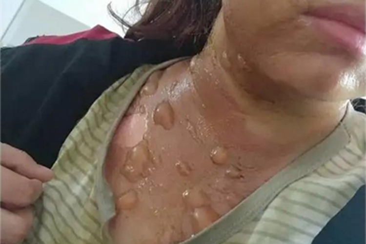 二度烫伤胸部症状图 二度烫伤胸部症状图