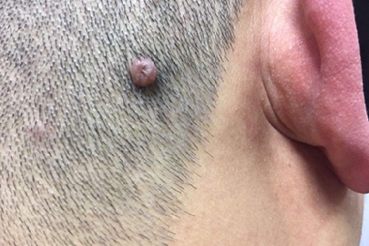 网状组织细胞肉芽肿头皮症状图 网状组织细胞肉芽肿头皮症状图