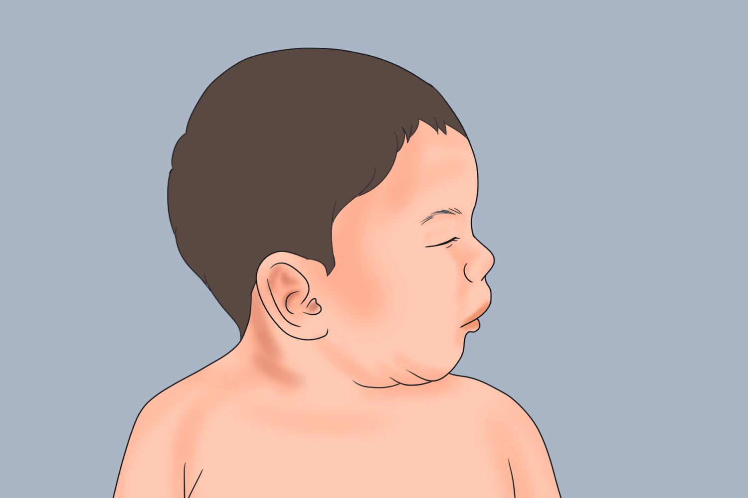 婴儿小下颌畸形图片图片
