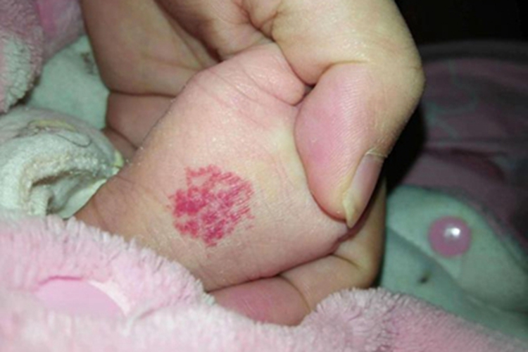 浅表型婴儿血管瘤脚底红点图