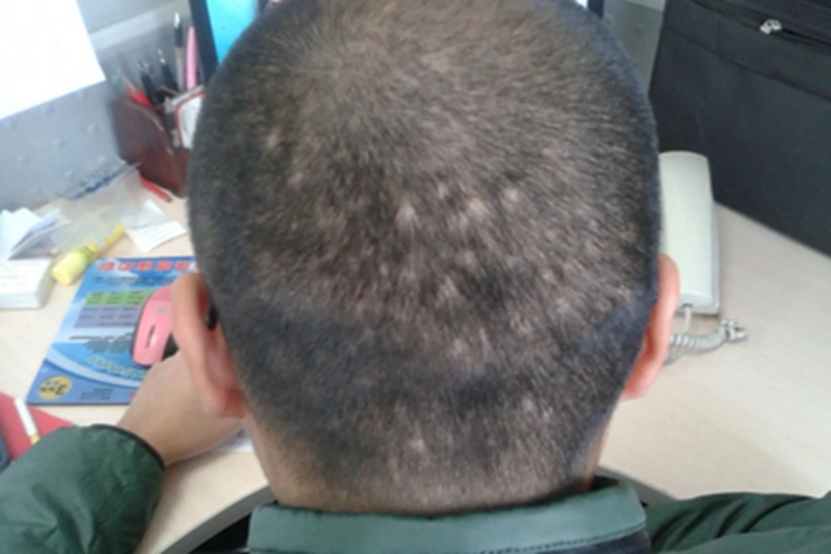 进展期斑秃症状图