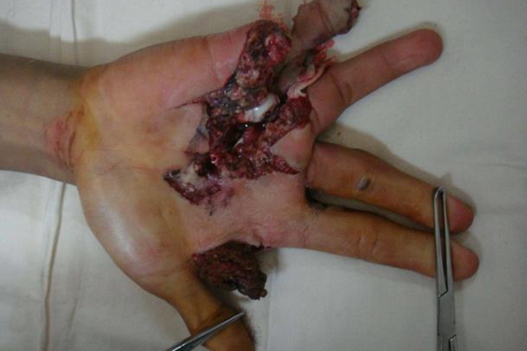 手筋断了图 手筋断了图