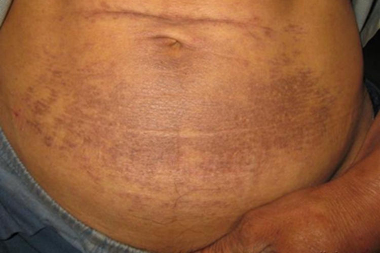 焦油黑变病腹部皮肤发黑图 焦油黑变病腹部皮肤发黑图