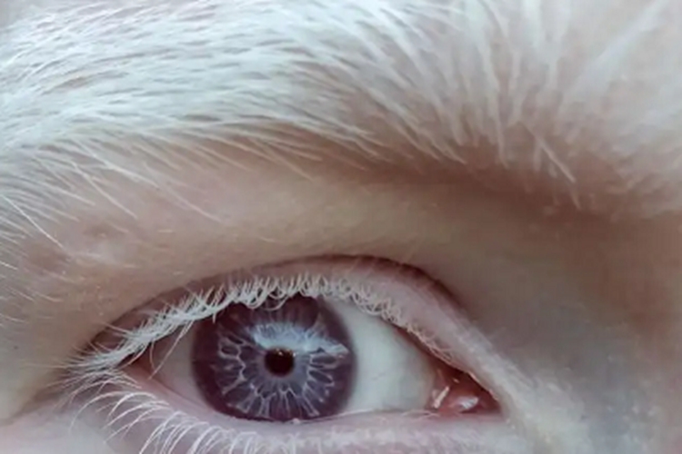 外阴白化病症状图