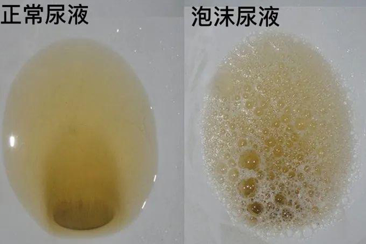 正常尿和蛋白尿图