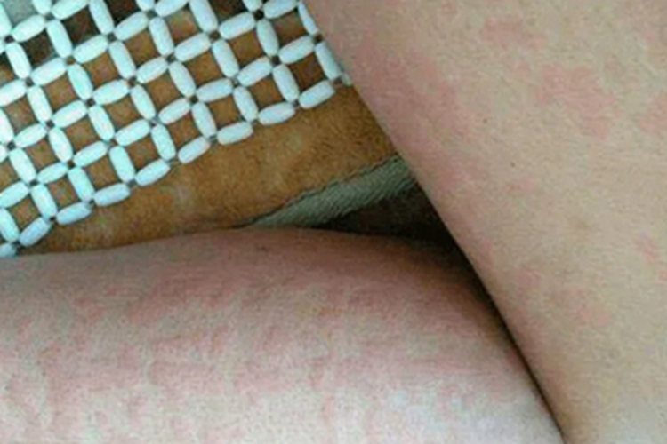 荨麻疹腿风团图 荨麻疹腿风团图