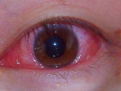 红眼病白眼球充血布满红血丝图