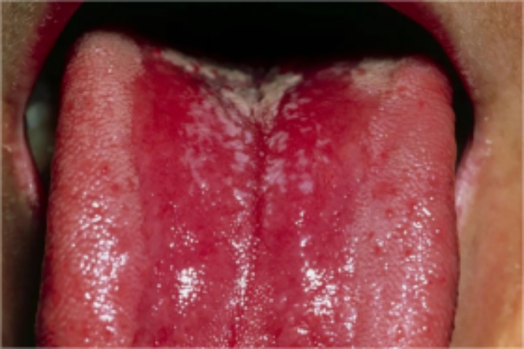 急性红斑型念珠菌性口炎图