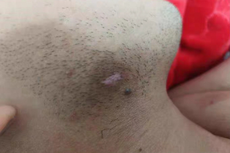 稳定期节段型白癜风下巴长白斑图 稳定期节段型白癜风下巴长白斑图