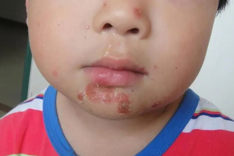 寻常型脓疱疮图