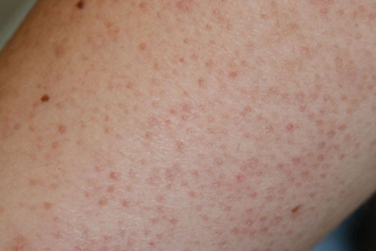 鳞状毛囊角化病胳膊症状图 鳞状毛囊角化病胳膊症状图