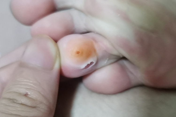 硬鸡眼脚趾皮肤发黄图