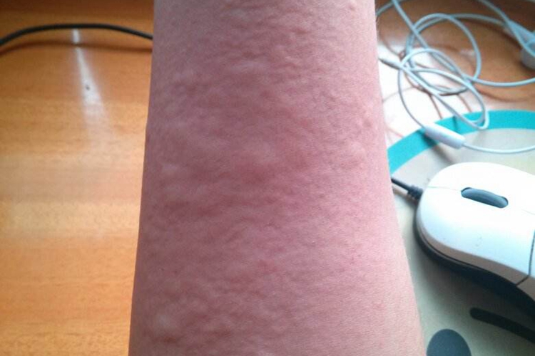 吃山竹过敏出现风团图