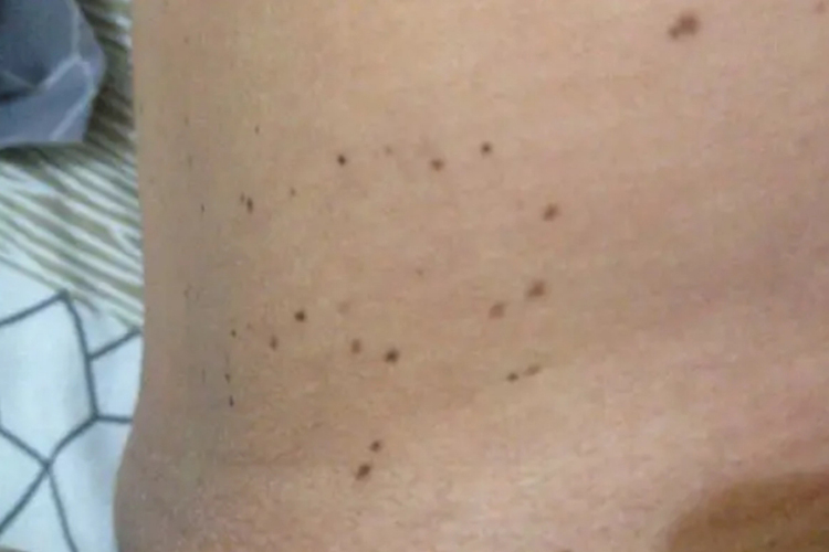 神经纤维瘤的腹股沟雀斑图