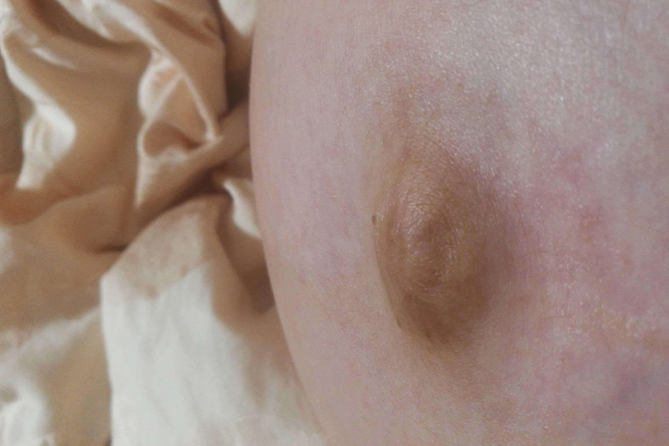 怀孕肚脐凸起图