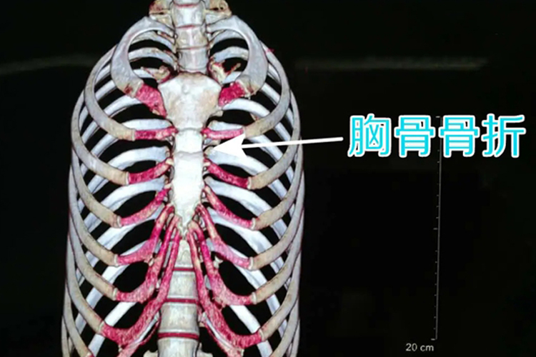 胸骨骨折影像学图