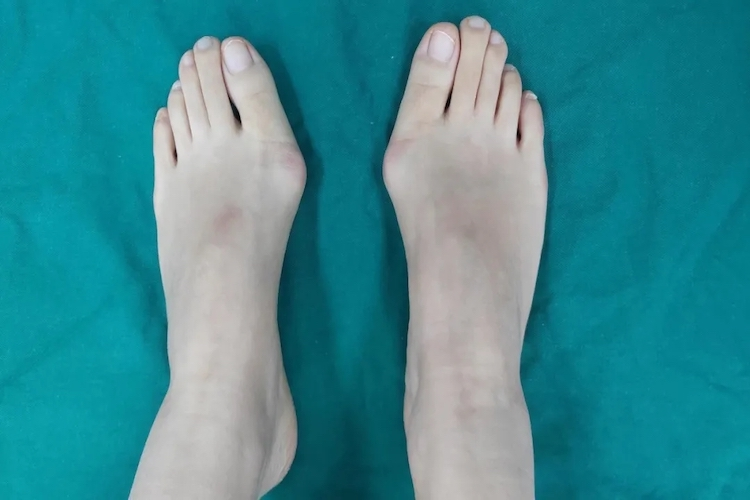 拇外翻挛缩阶段