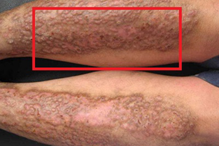 继发性皮肤淀粉样变血痂图