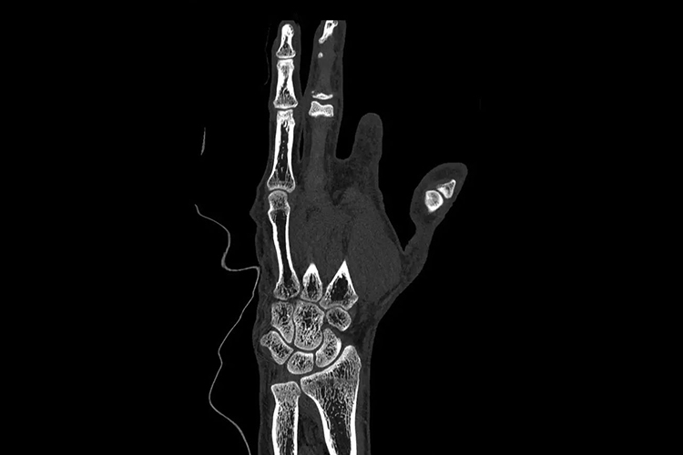 手部CT无名指图