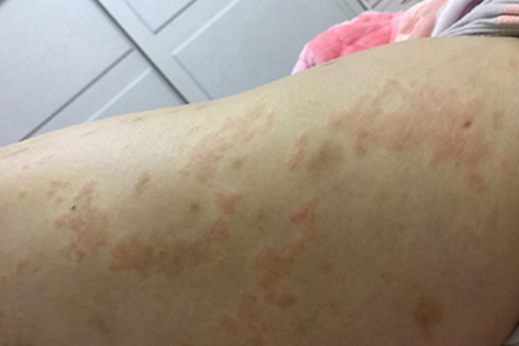 湿疹样紫癜大腿症状图 湿疹样紫癜大腿症状图