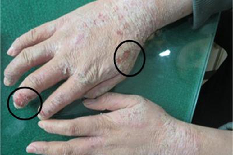 儿童期特应性皮炎手部溃疡图