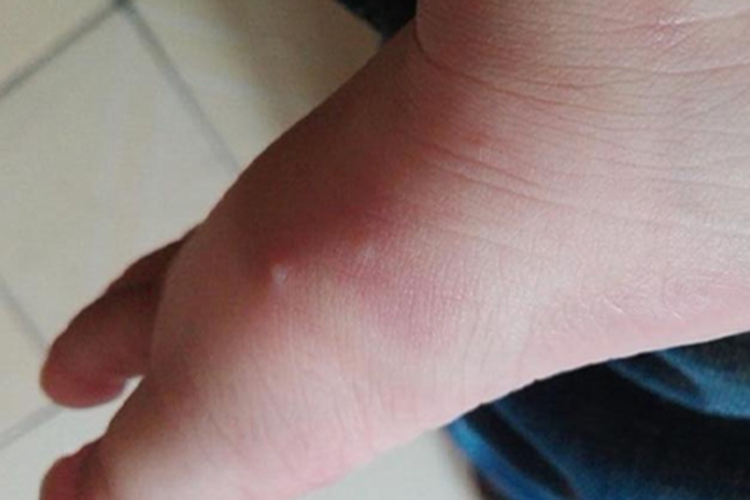 水痘脚部长小水疱图