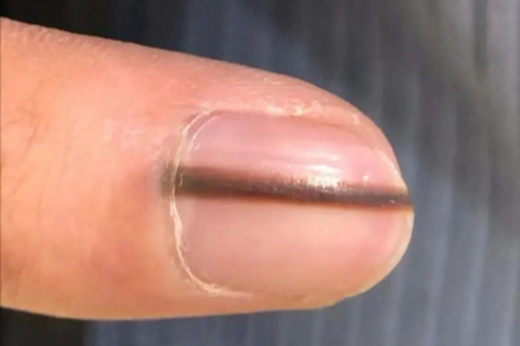 恶性黑色素瘤手指甲黑斑图