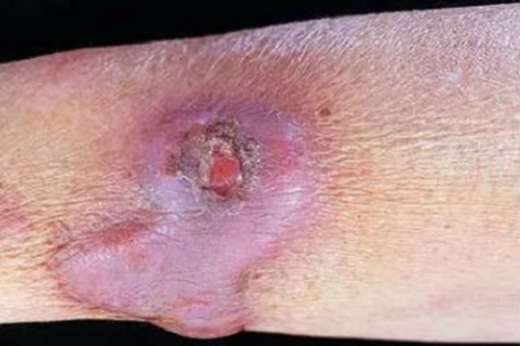 海鱼分枝杆菌感染糜烂图