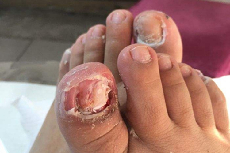 慢性化脓性甲沟炎脚趾肿图