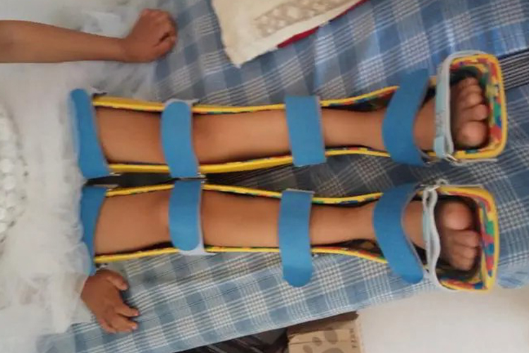 儿童膝外翻佩戴支具图