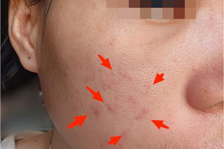 痤疮脸上有少量红色疙瘩图 痤疮脸上有少量红色疙瘩图