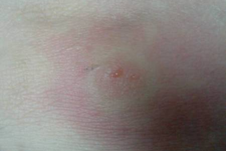 手被蟑螂咬了水疱图