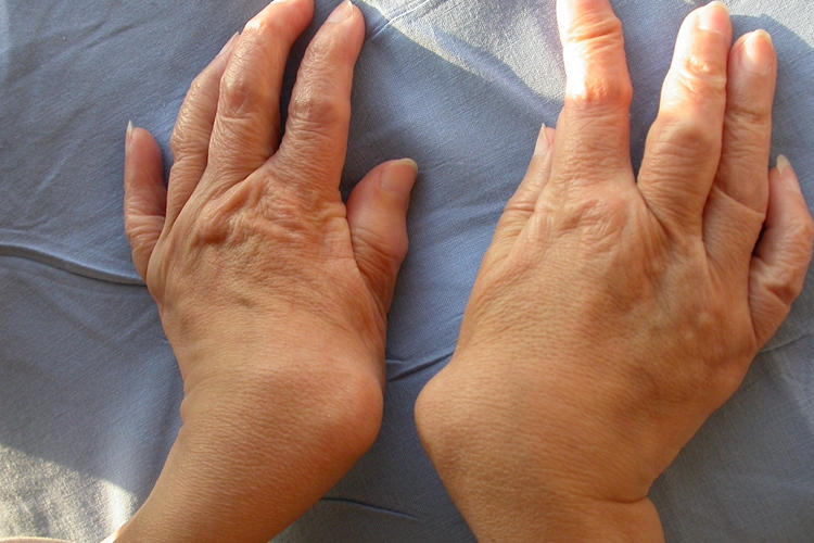 类风湿性关节炎关节畸形图 类风湿性关节炎关节畸形图