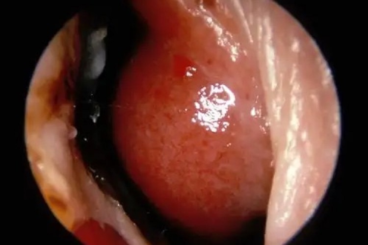 鼻腔黏膜出血点图