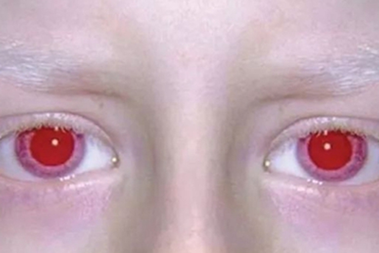 眼皮肤白化病症状图