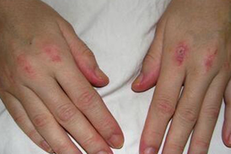 无肌病性皮肌炎手部症状图 无肌病性皮肌炎手部症状图