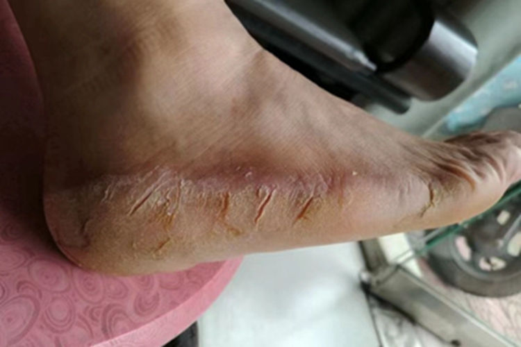 手足皲裂皲裂图