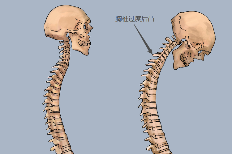 胸椎后凸正常范围图片