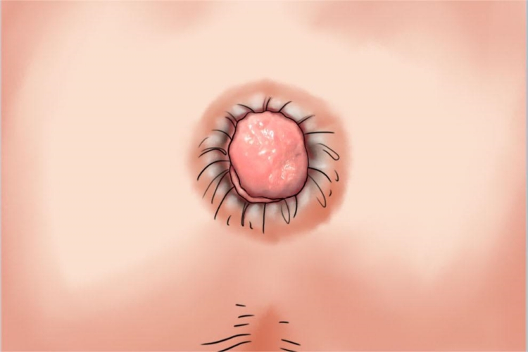 Ⅲ度内痔疙瘩手绘图 Ⅲ度内痔疙瘩手绘图