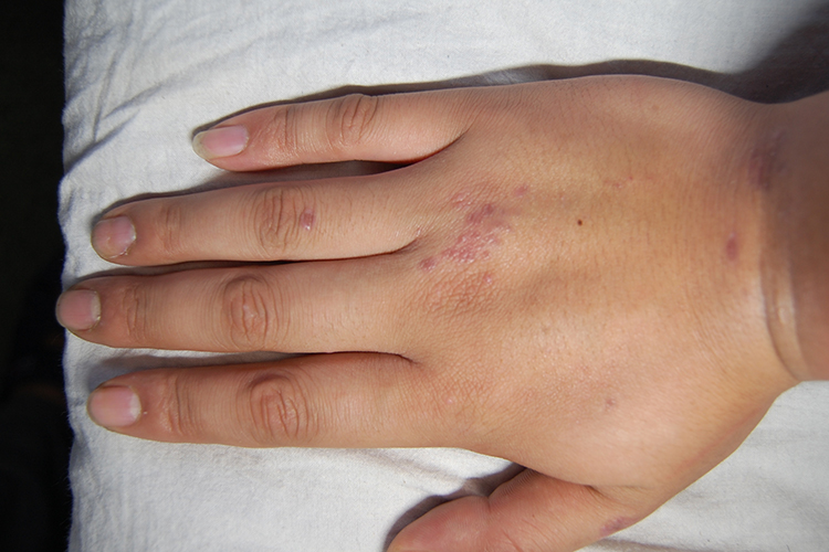 手上湿疹图