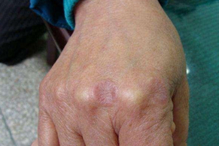 环状扁平苔藓手背红斑图 环状扁平苔藓手背红斑图