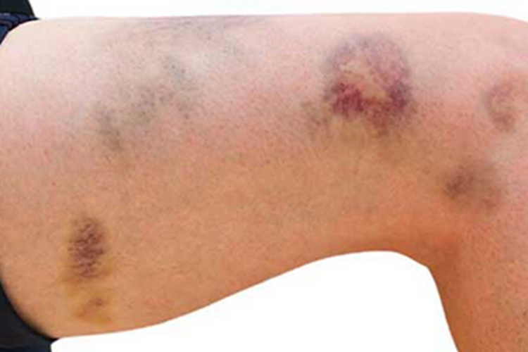 皮肤白血病大腿斑图