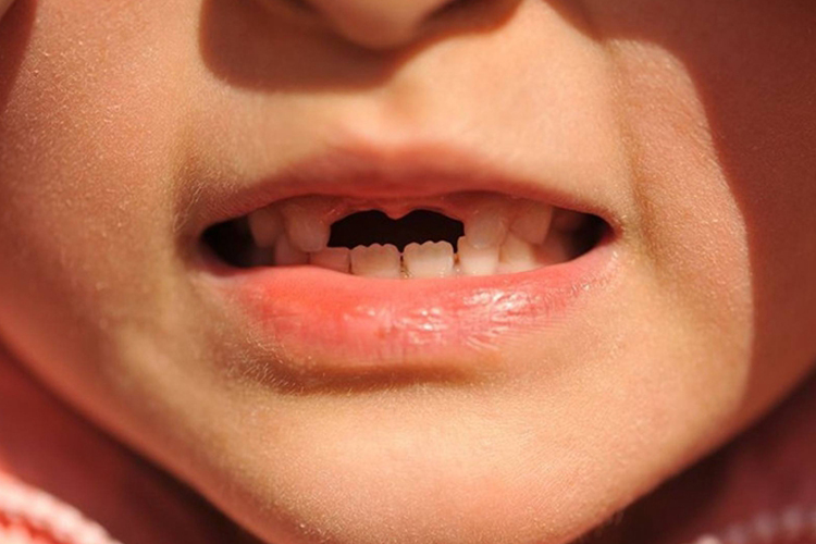 乳牙门牙掉下来图