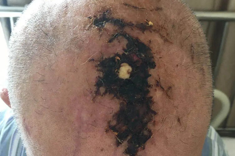 头皮坏死图 头皮坏死图