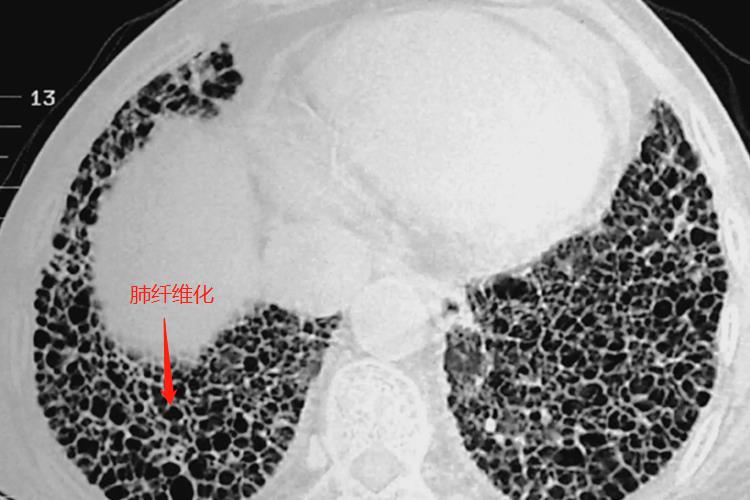 肺纤维化CT图